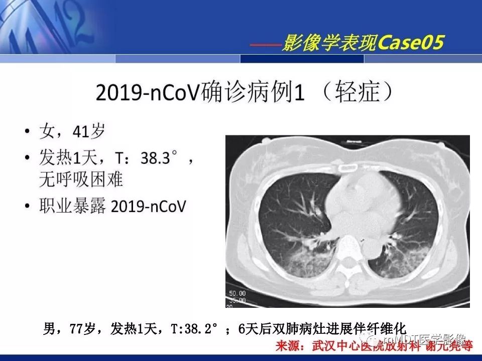 【PPT】新型冠状病毒肺炎的诊断与鉴别诊断