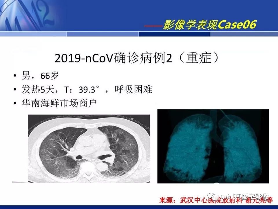 【PPT】新型冠状病毒肺炎的诊断与鉴别诊断