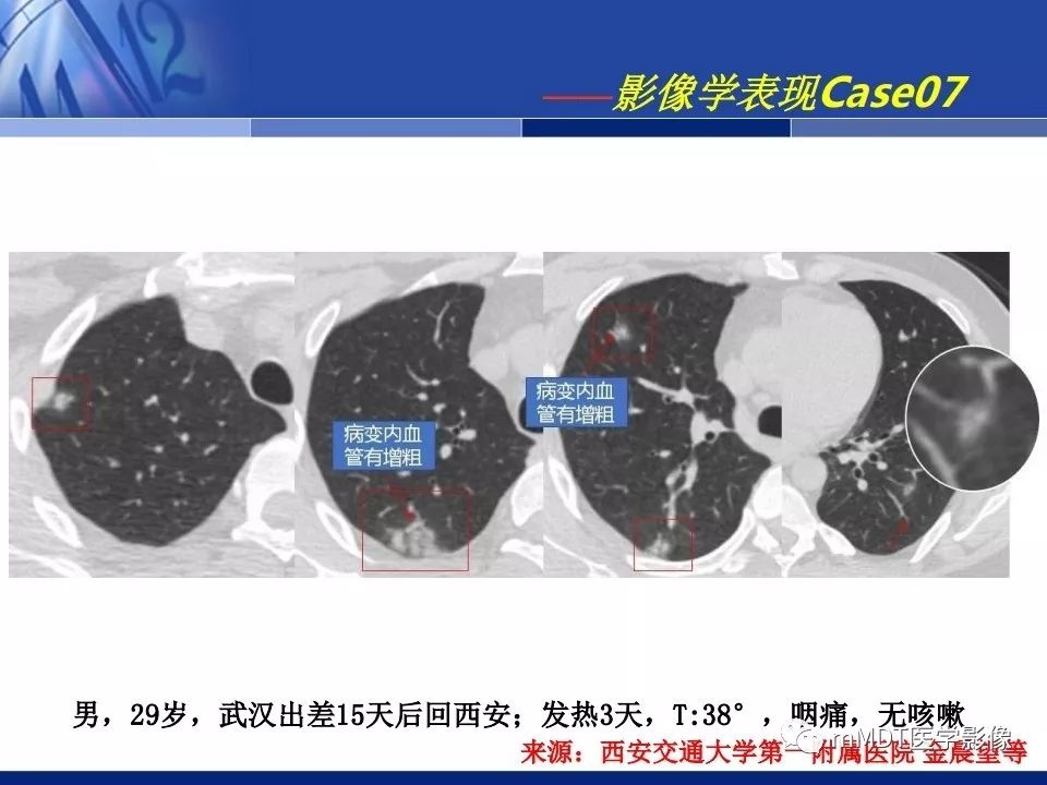 【PPT】新型冠状病毒肺炎的诊断与鉴别诊断