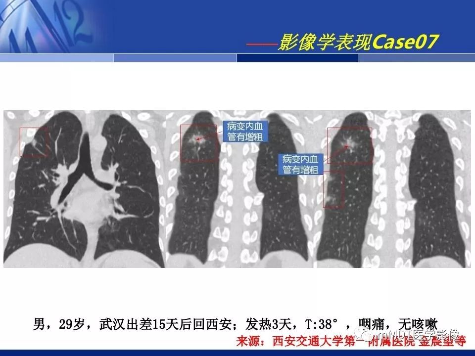 【PPT】新型冠状病毒肺炎的诊断与鉴别诊断