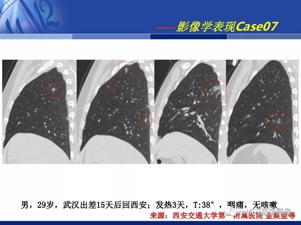【PPT】新型冠状病毒肺炎的诊断与鉴别诊断