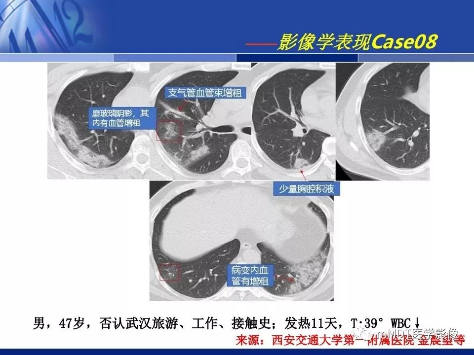 【PPT】新型冠状病毒肺炎的诊断与鉴别诊断