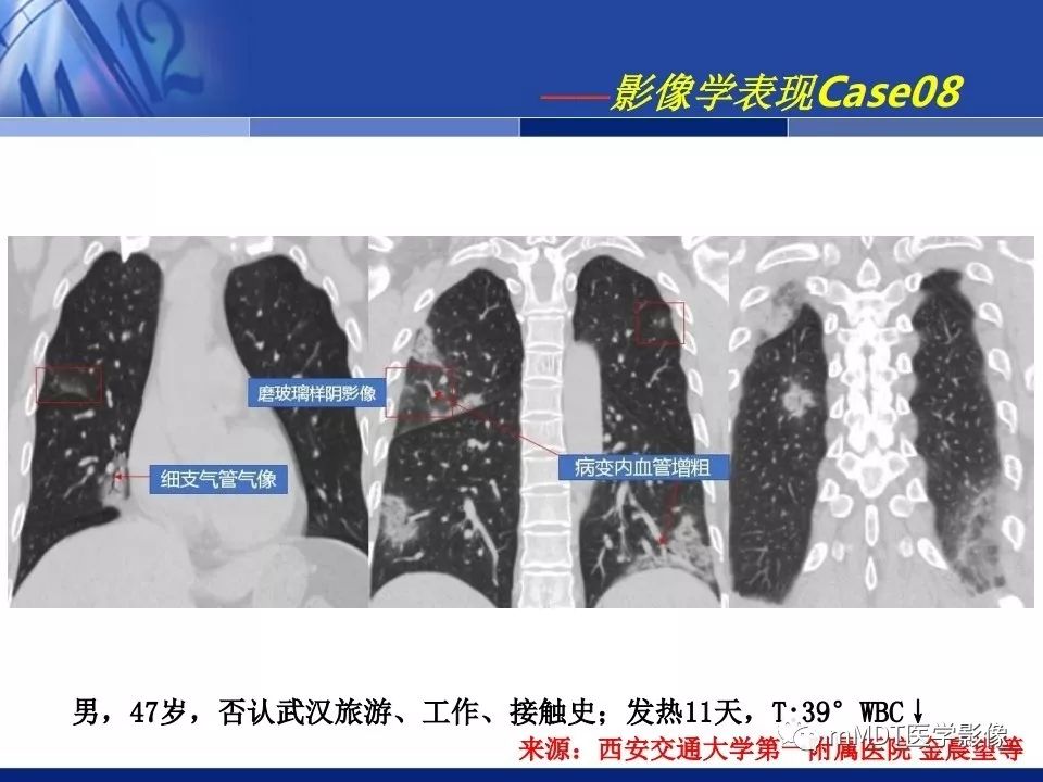 【PPT】新型冠状病毒肺炎的诊断与鉴别诊断