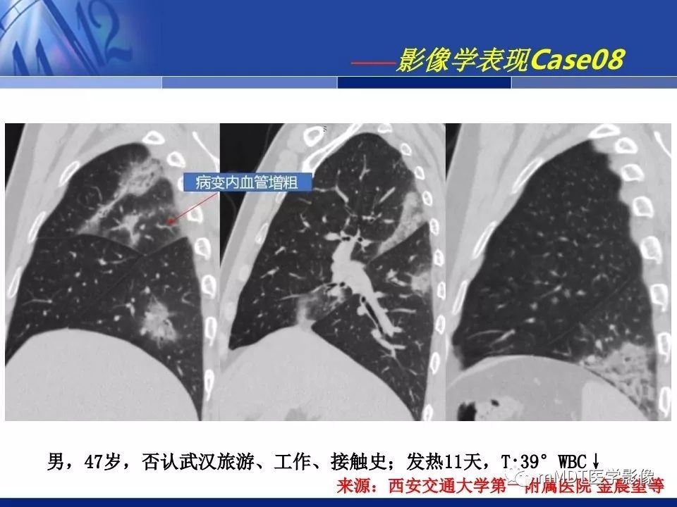 【PPT】新型冠状病毒肺炎的诊断与鉴别诊断