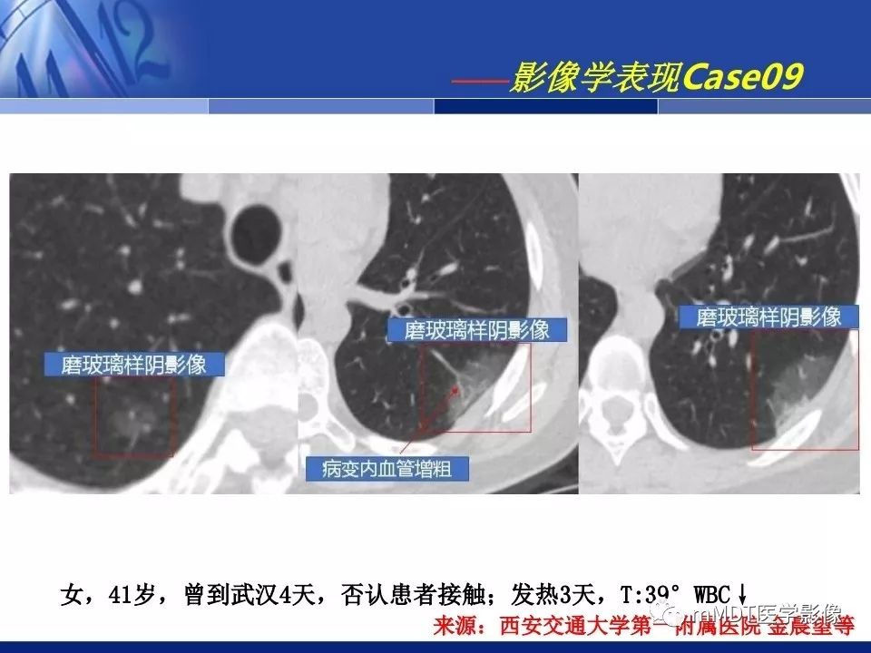 【PPT】新型冠状病毒肺炎的诊断与鉴别诊断