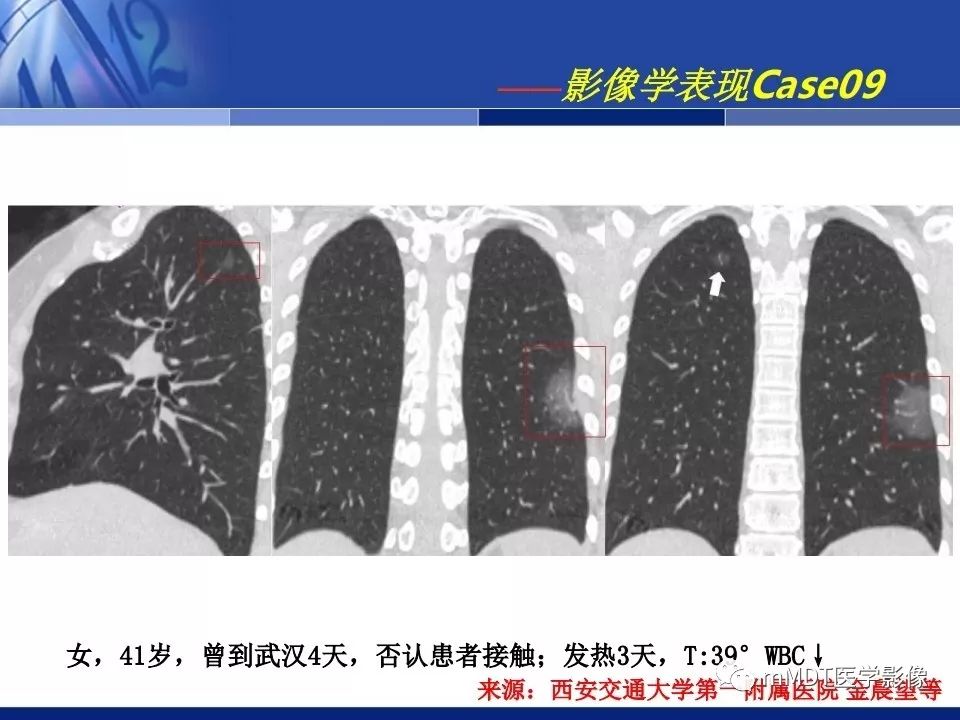 【PPT】新型冠状病毒肺炎的诊断与鉴别诊断