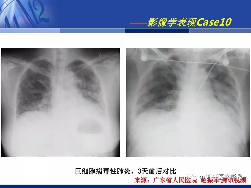 【PPT】新型冠状病毒肺炎的诊断与鉴别诊断