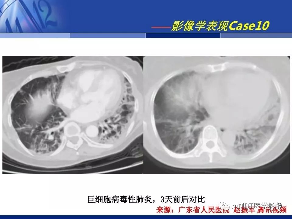 【PPT】新型冠状病毒肺炎的诊断与鉴别诊断