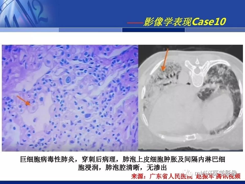 【PPT】新型冠状病毒肺炎的诊断与鉴别诊断