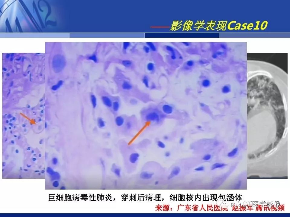【PPT】新型冠状病毒肺炎的诊断与鉴别诊断