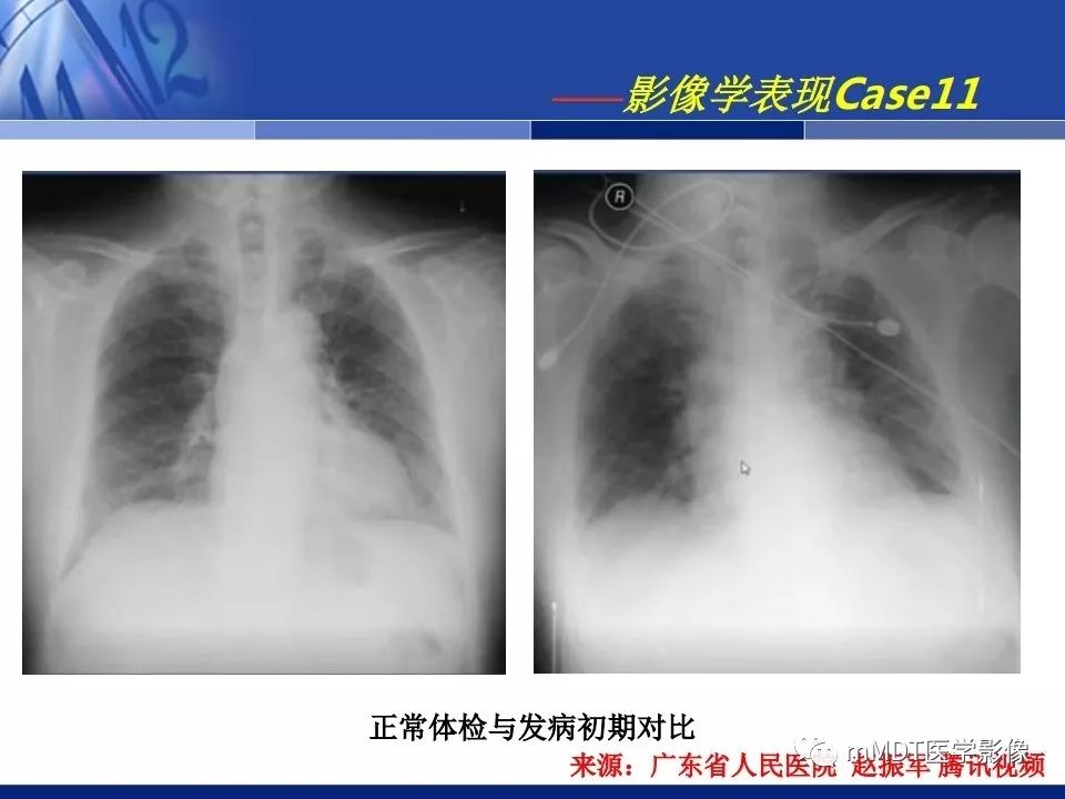 【PPT】新型冠状病毒肺炎的诊断与鉴别诊断