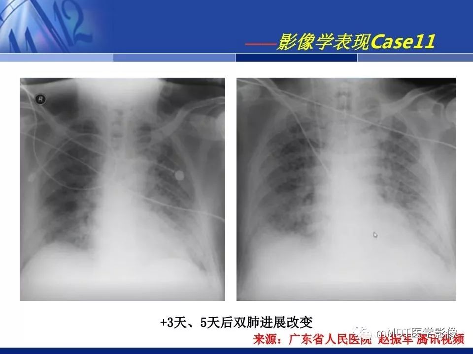 【PPT】新型冠状病毒肺炎的诊断与鉴别诊断