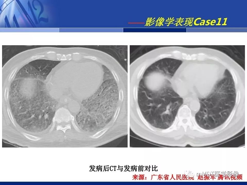 【PPT】新型冠状病毒肺炎的诊断与鉴别诊断