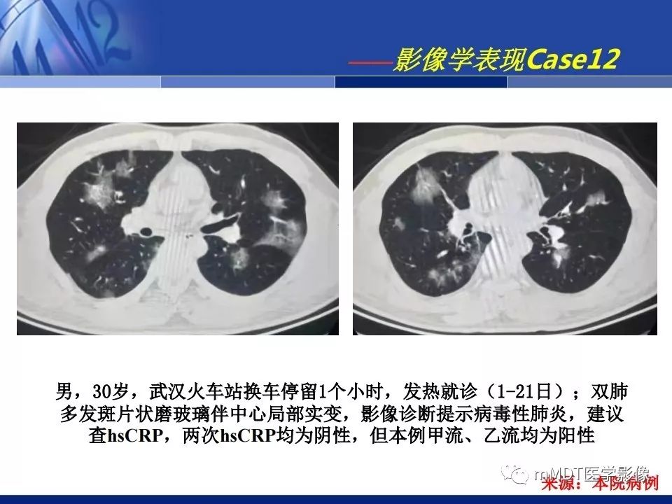 【PPT】新型冠状病毒肺炎的诊断与鉴别诊断