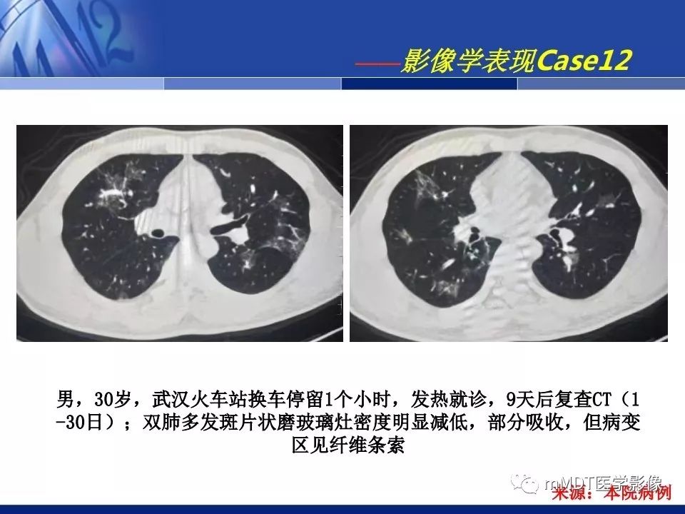 【PPT】新型冠状病毒肺炎的诊断与鉴别诊断