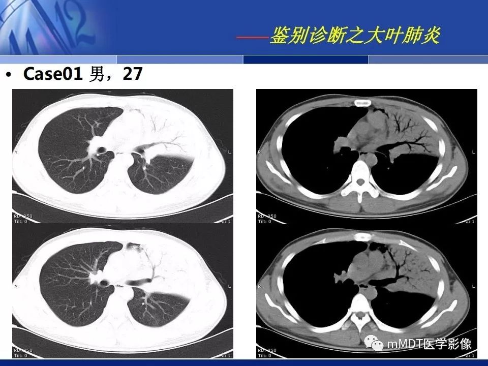 【PPT】新型冠状病毒肺炎的诊断与鉴别诊断
