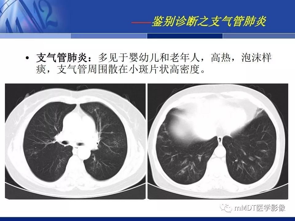 【PPT】新型冠状病毒肺炎的诊断与鉴别诊断