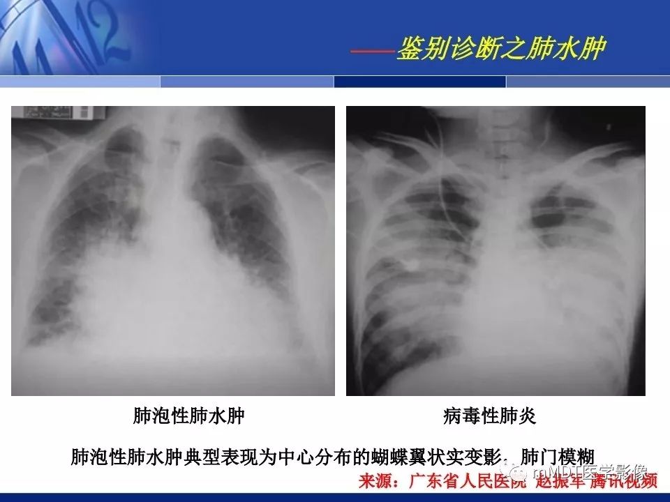 【PPT】新型冠状病毒肺炎的诊断与鉴别诊断