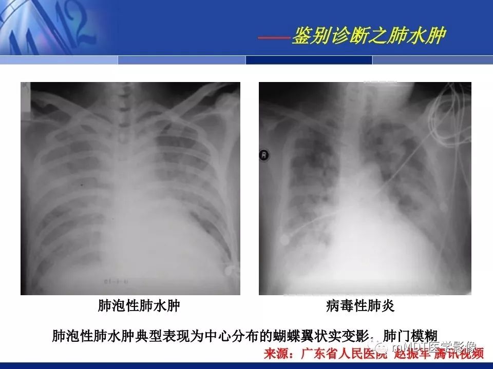 【PPT】新型冠状病毒肺炎的诊断与鉴别诊断