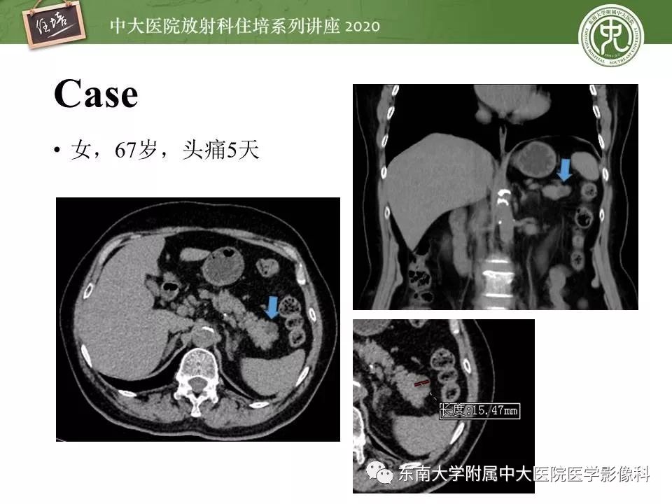 【PPT】胰腺良恶性病变的影像分析思路