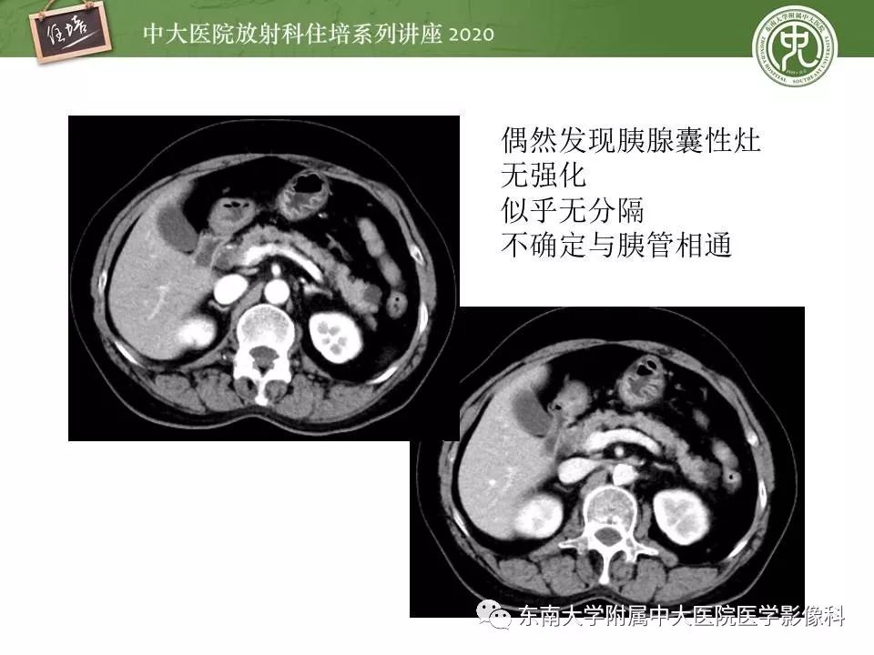 【PPT】胰腺良恶性病变的影像分析思路