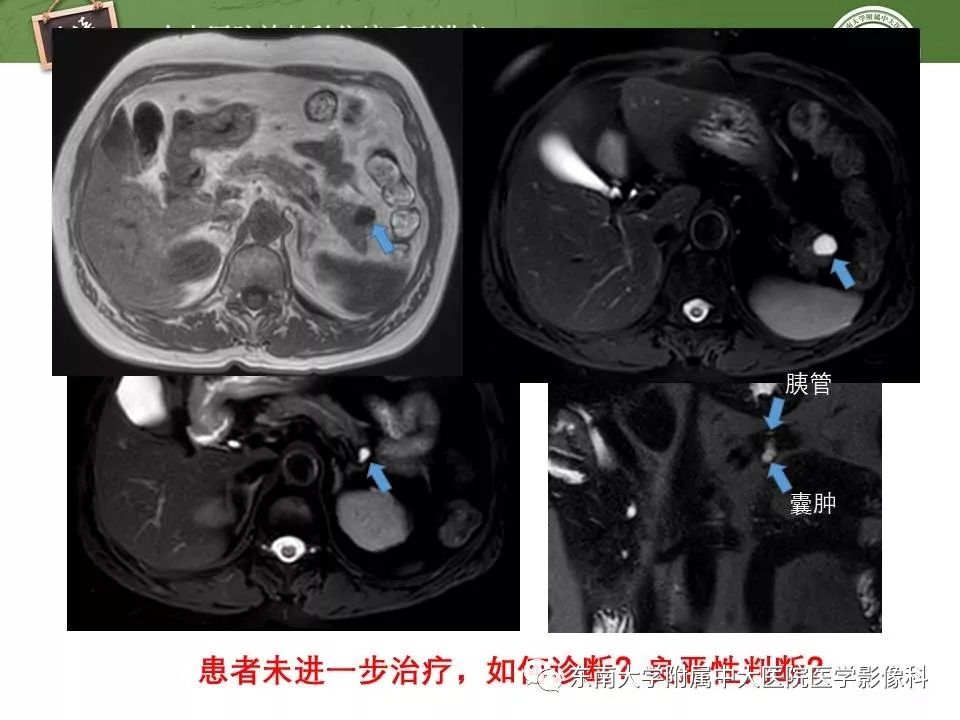 【PPT】胰腺良恶性病变的影像分析思路