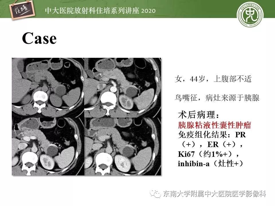 【PPT】胰腺良恶性病变的影像分析思路