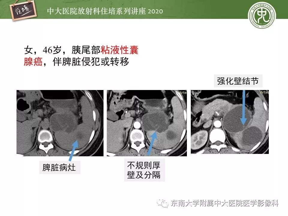 【PPT】胰腺良恶性病变的影像分析思路