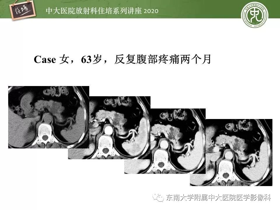 【PPT】胰腺良恶性病变的影像分析思路