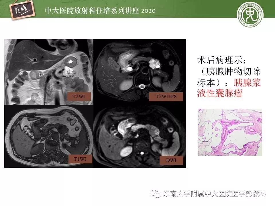 【PPT】胰腺良恶性病变的影像分析思路