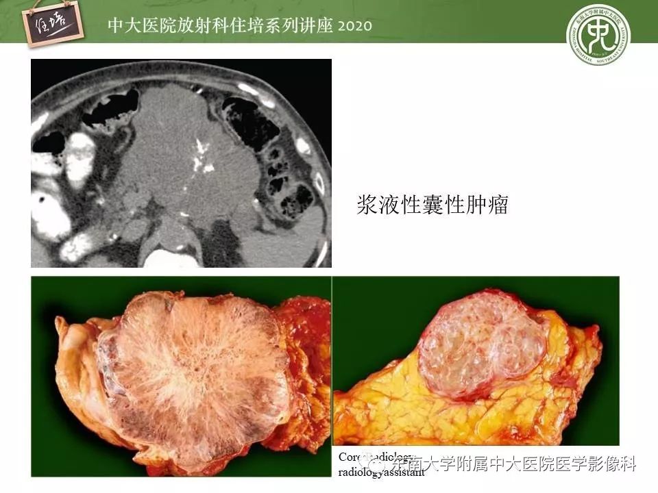 【PPT】胰腺良恶性病变的影像分析思路