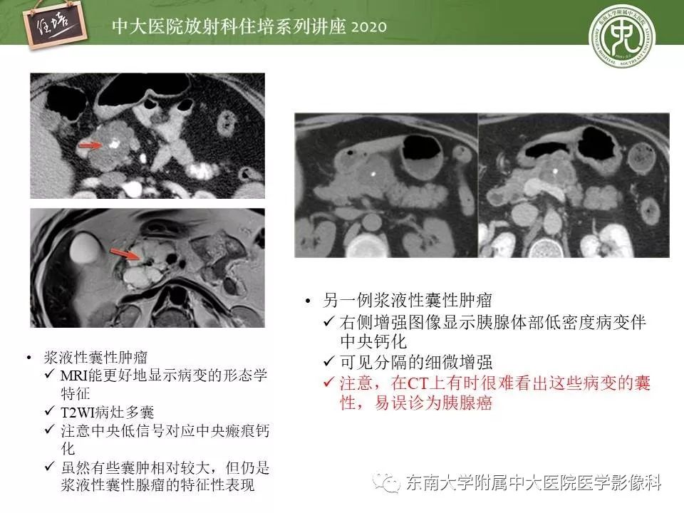 【PPT】胰腺良恶性病变的影像分析思路