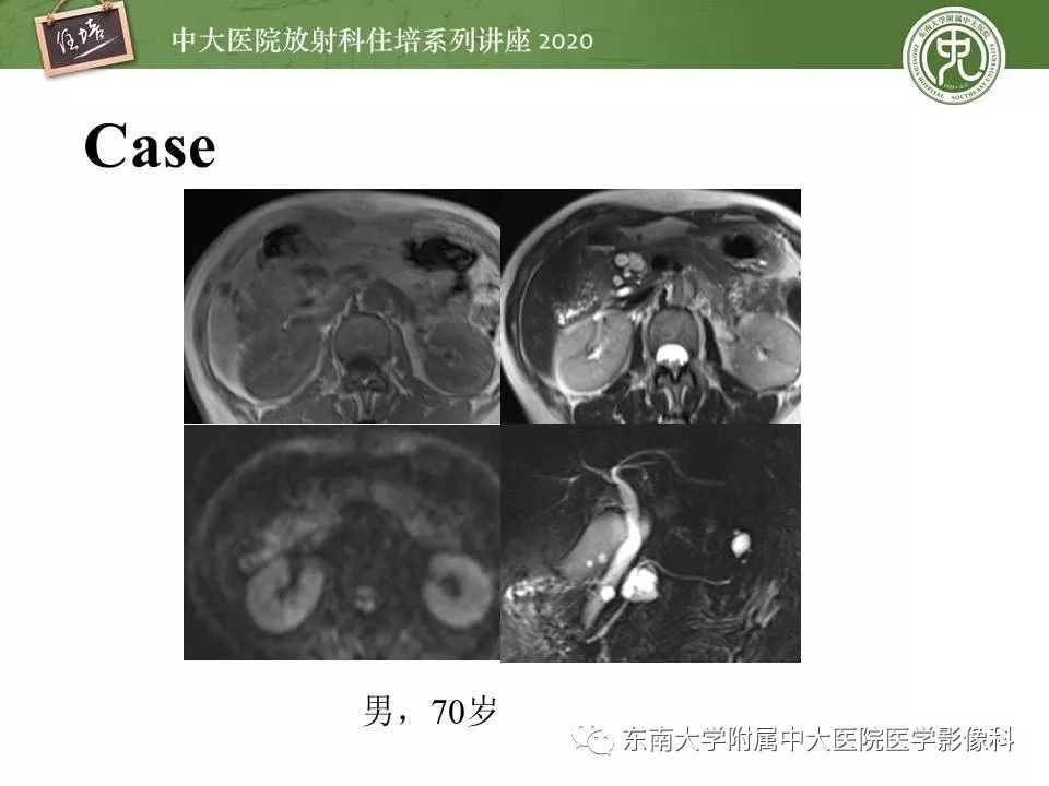【PPT】胰腺良恶性病变的影像分析思路