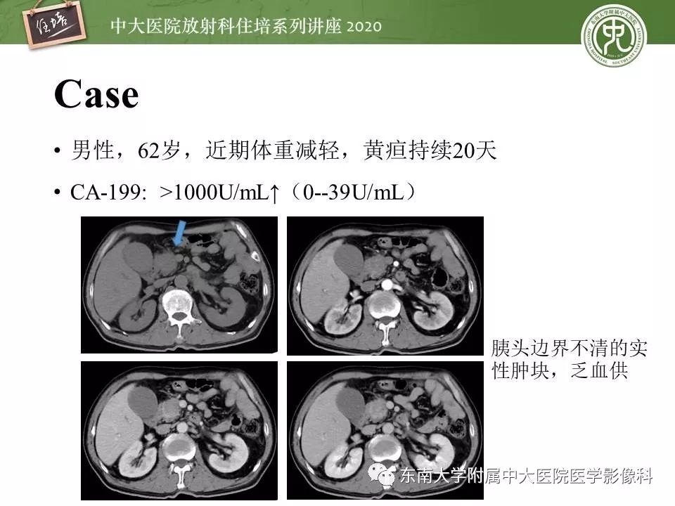 【PPT】胰腺良恶性病变的影像分析思路