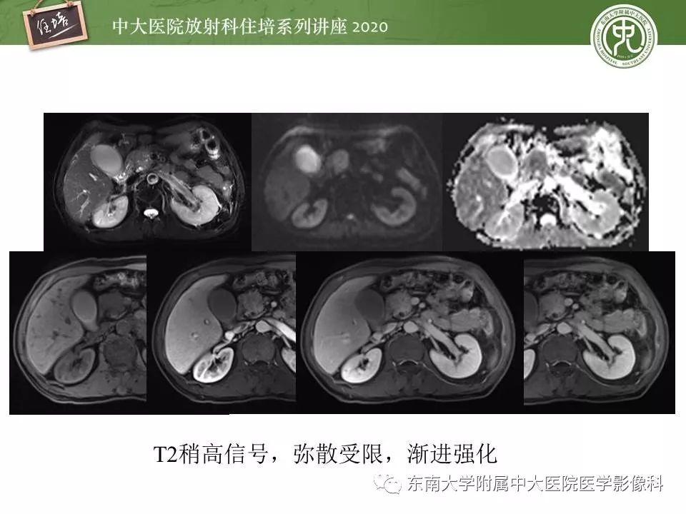 【PPT】胰腺良恶性病变的影像分析思路