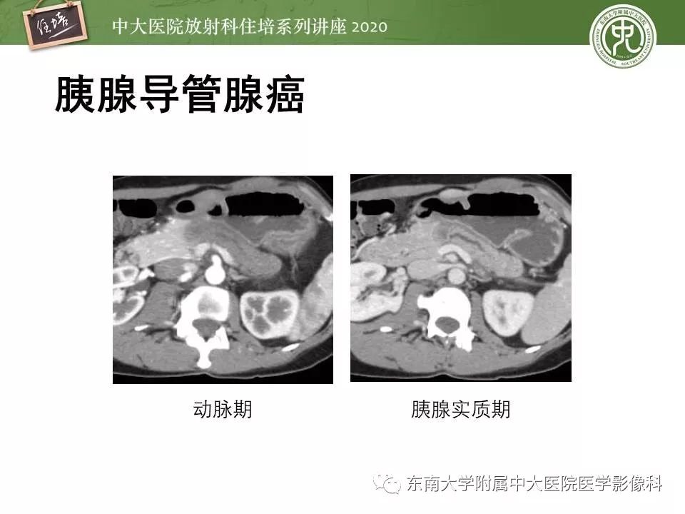 【PPT】胰腺良恶性病变的影像分析思路
