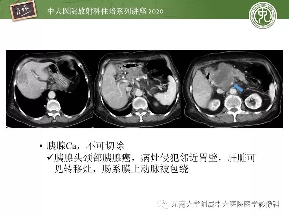 【PPT】胰腺良恶性病变的影像分析思路