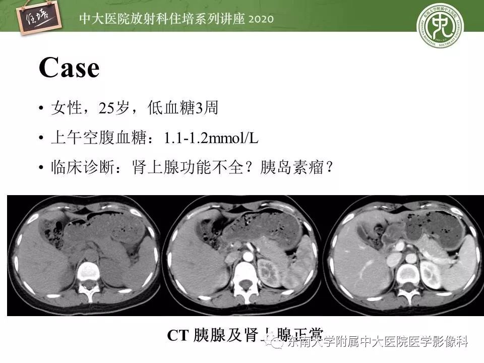 【PPT】胰腺良恶性病变的影像分析思路