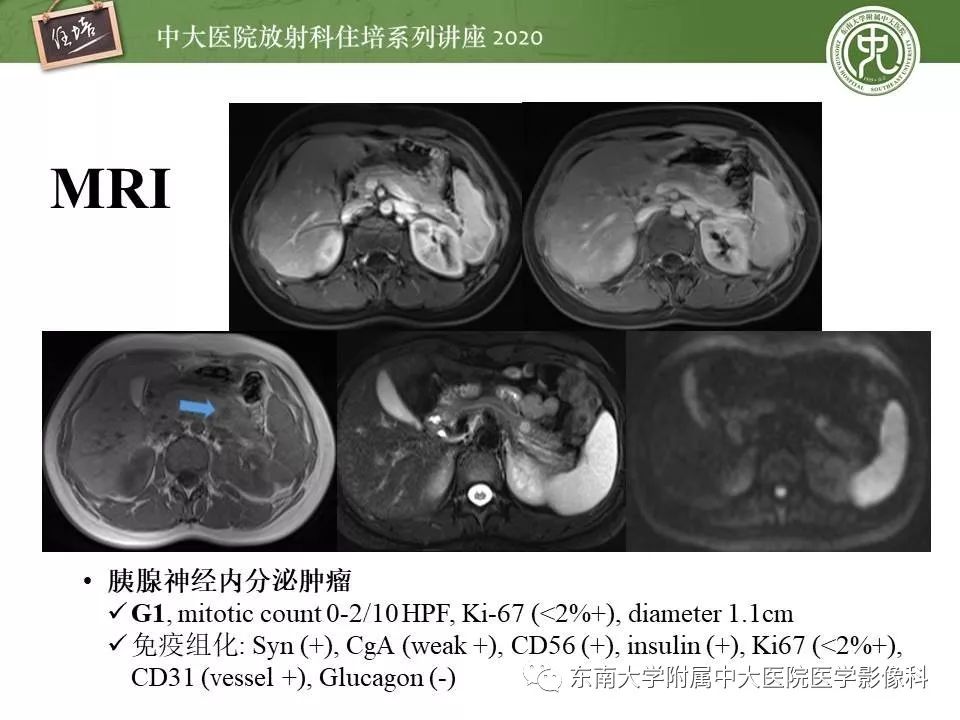 【PPT】胰腺良恶性病变的影像分析思路