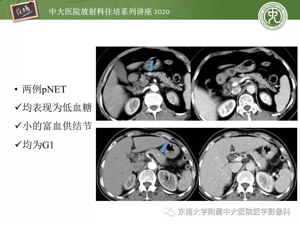 【PPT】胰腺良恶性病变的影像分析思路