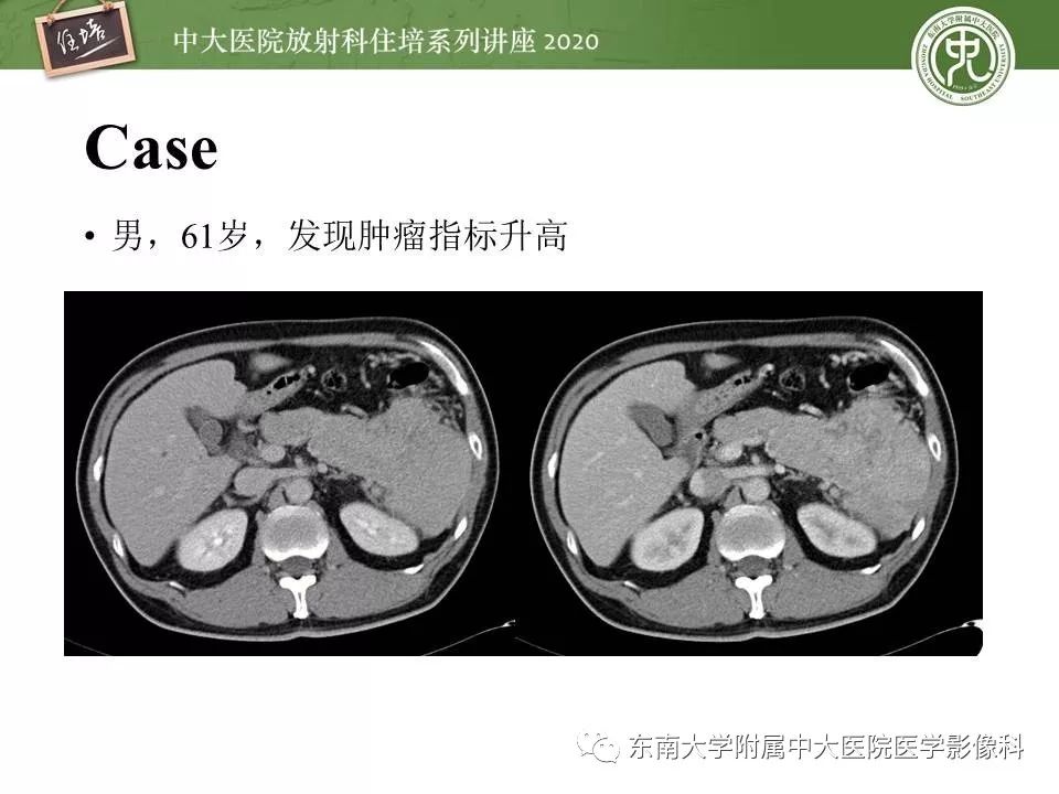 【PPT】胰腺良恶性病变的影像分析思路