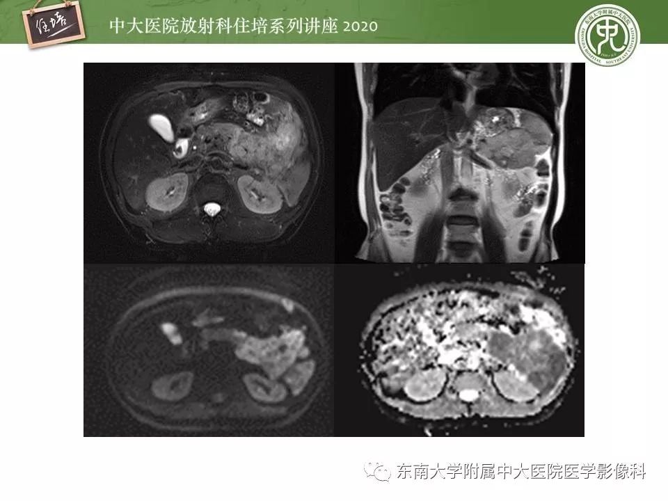 【PPT】胰腺良恶性病变的影像分析思路