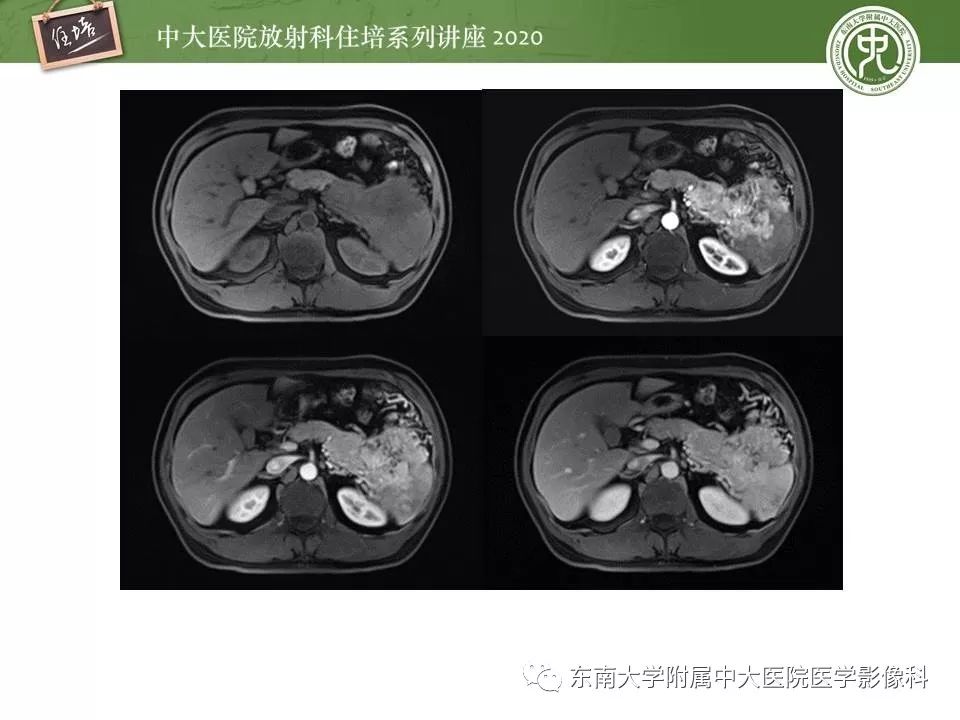 【PPT】胰腺良恶性病变的影像分析思路
