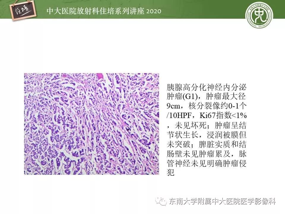 【PPT】胰腺良恶性病变的影像分析思路