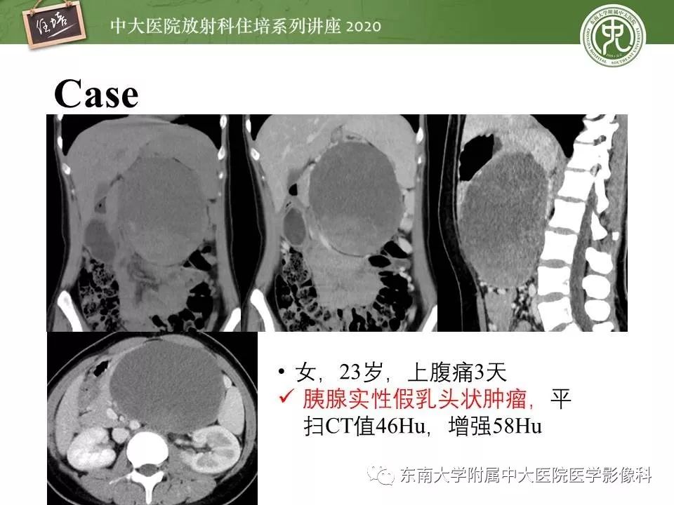 【PPT】胰腺良恶性病变的影像分析思路