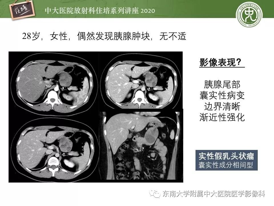【PPT】胰腺良恶性病变的影像分析思路
