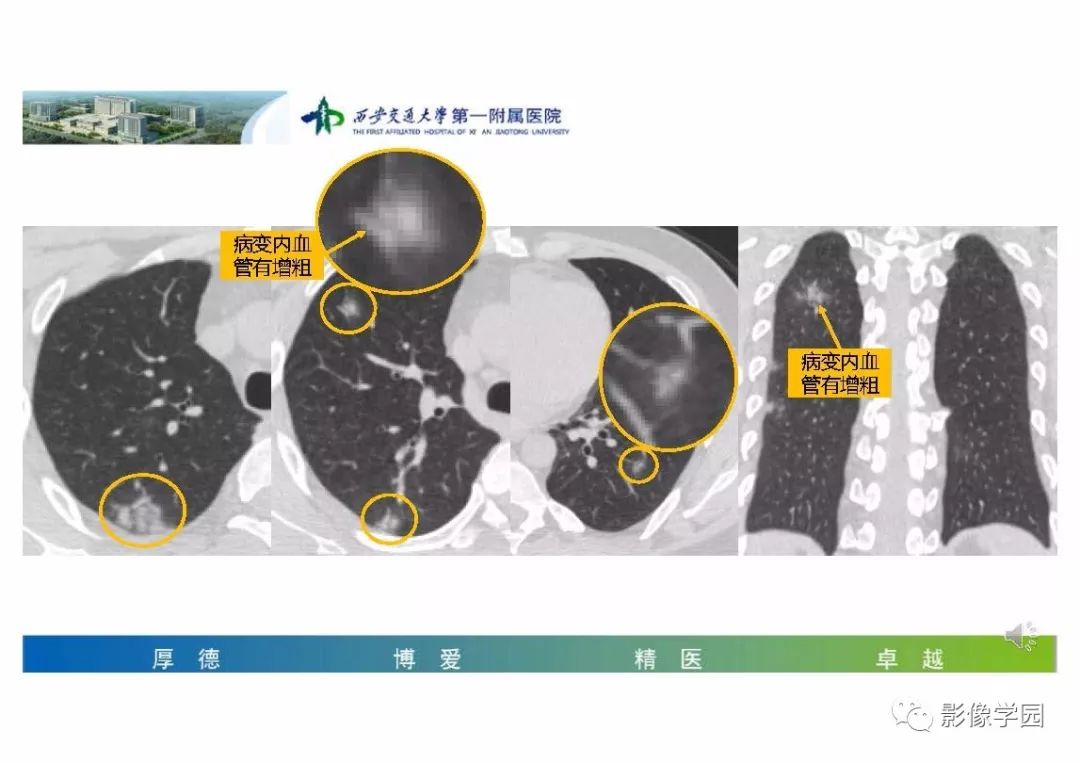 【PPT】输入性新冠肺炎的影像学特点与识别