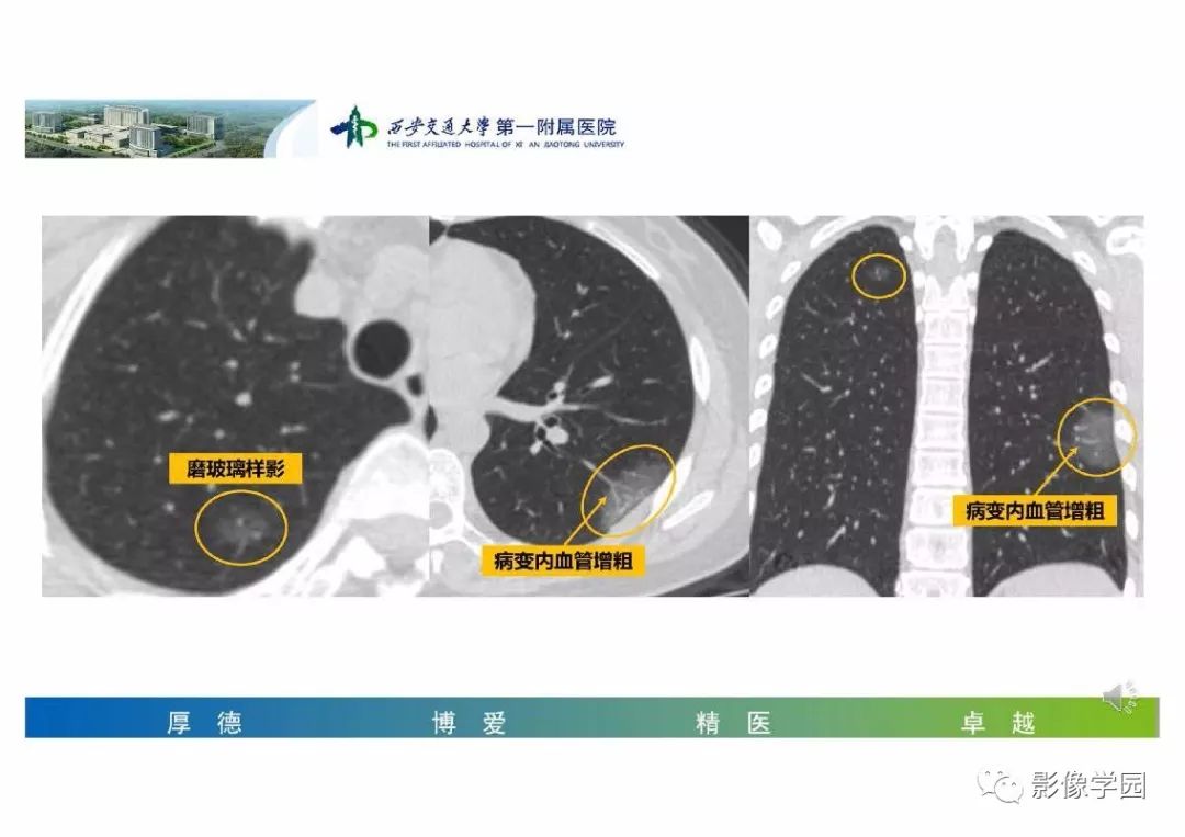 【PPT】输入性新冠肺炎的影像学特点与识别