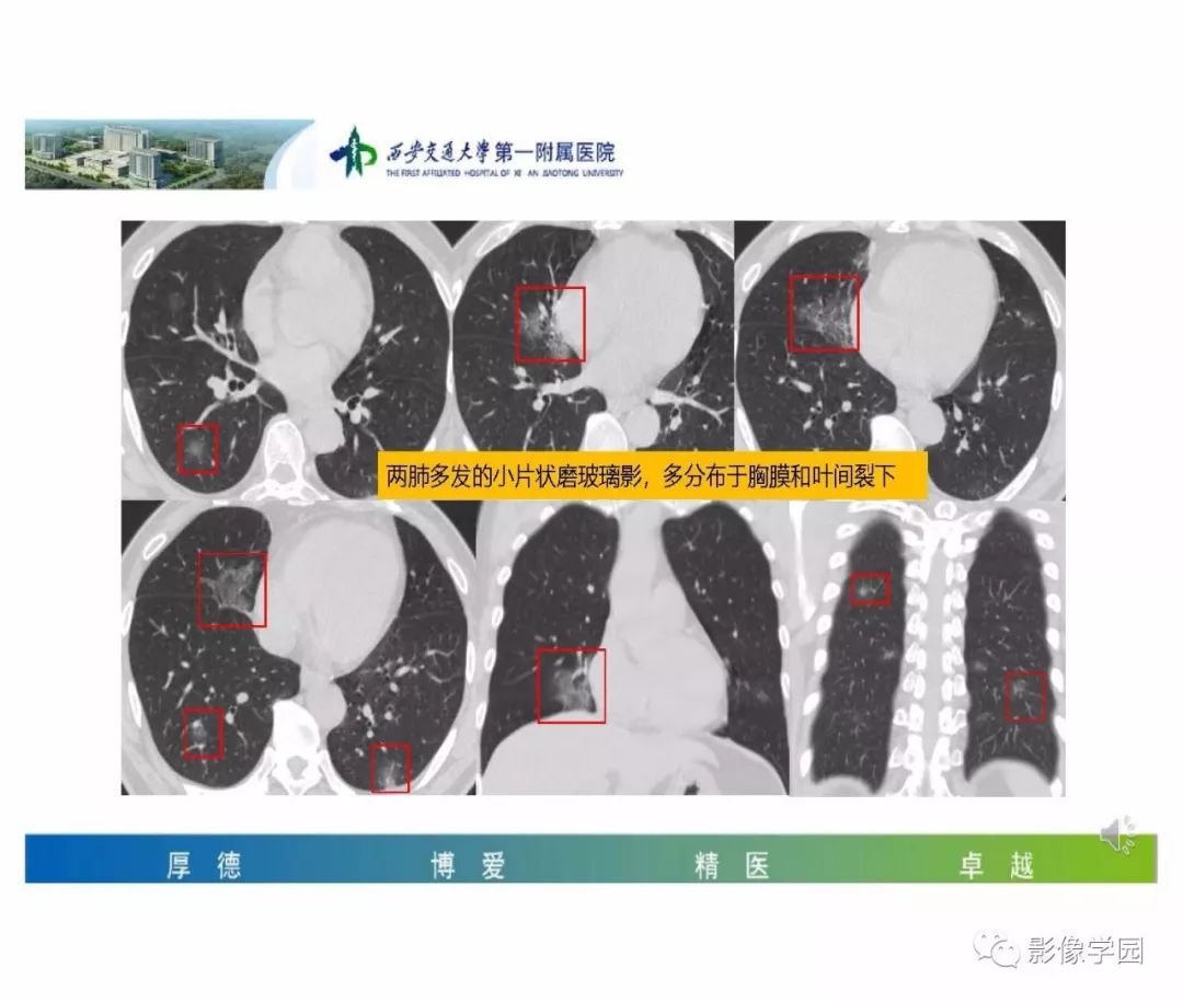 【PPT】输入性新冠肺炎的影像学特点与识别