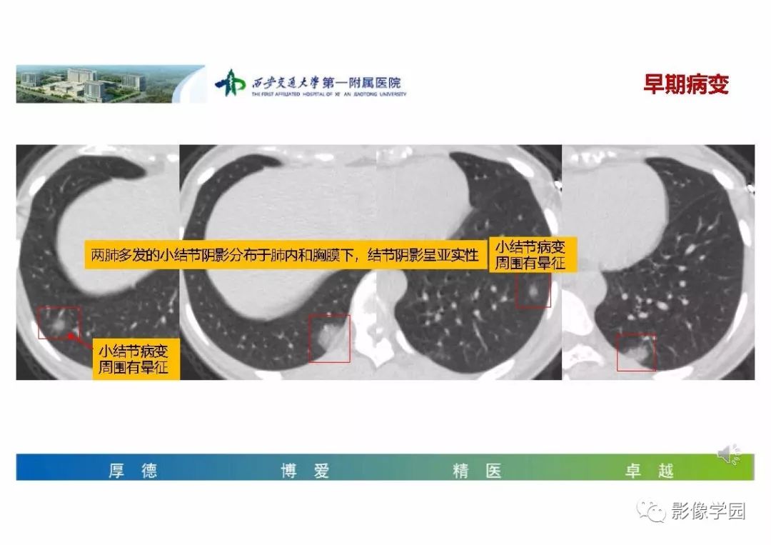 【PPT】输入性新冠肺炎的影像学特点与识别